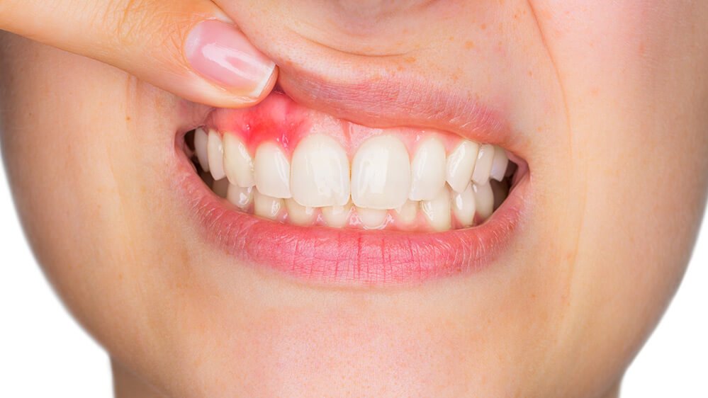 reduce gum inflammation oral health
